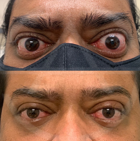 Orbital Decompression before and after images
