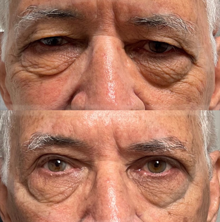 Male Blepharoplasty before and after images