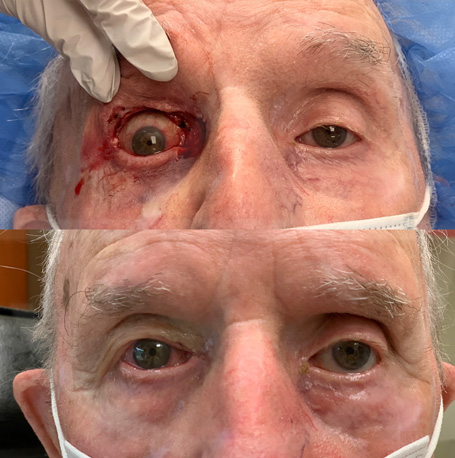 Mohs Reconstruction before and after images