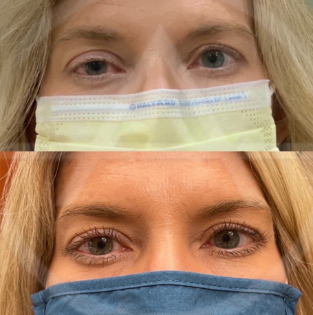 Ptosis before and after images