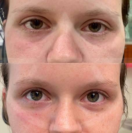 Dermal Fillers before and after images