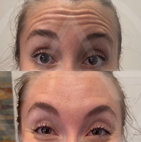 Neurotoxins before and after images