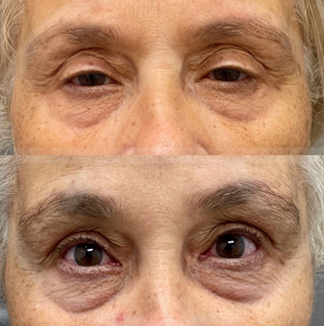 Ptosis before and after images