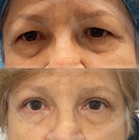 Brow Lift before and after images