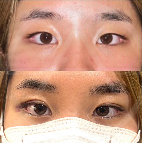 Asian eyelid before and after images