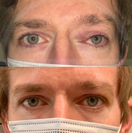 orbital tumor before and after images