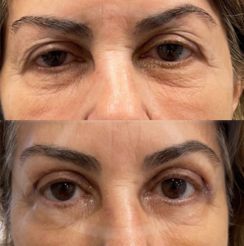 Upper eyelid before and after images