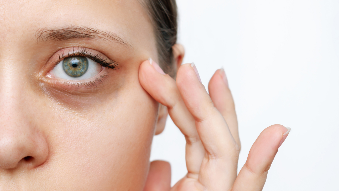 The image shows a woman with severe eye bags to illustrate which procedures can get rid of under-eye bags.