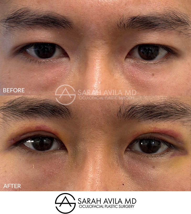 Asian Blepharoplasty Patient 01