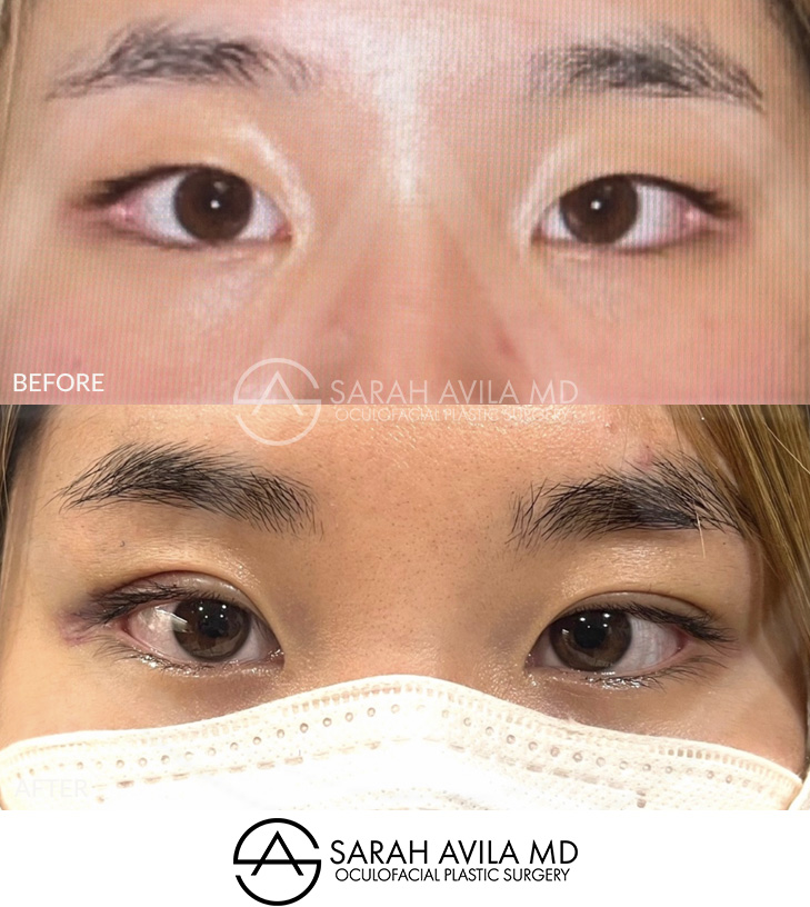 Asian Blepharoplasty Patient 02