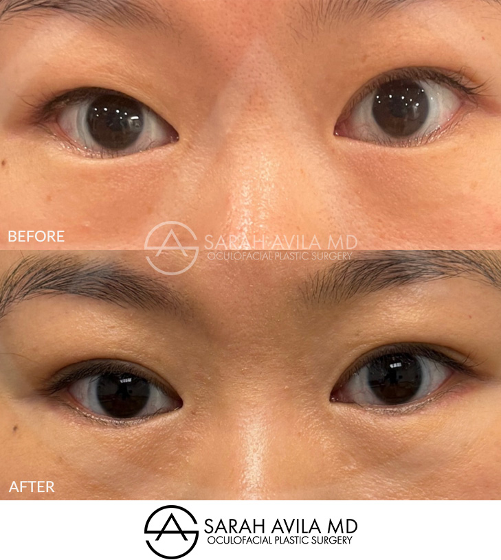 Asian Blepharoplasty Patient 03