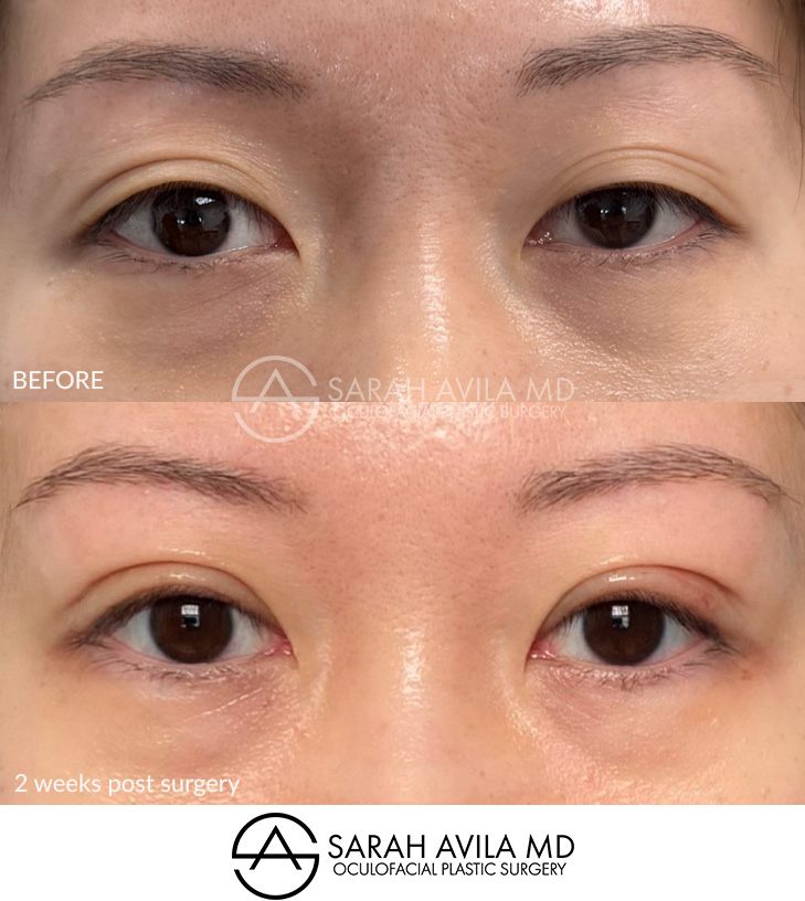 Asian Blepharoplasty Patient 04