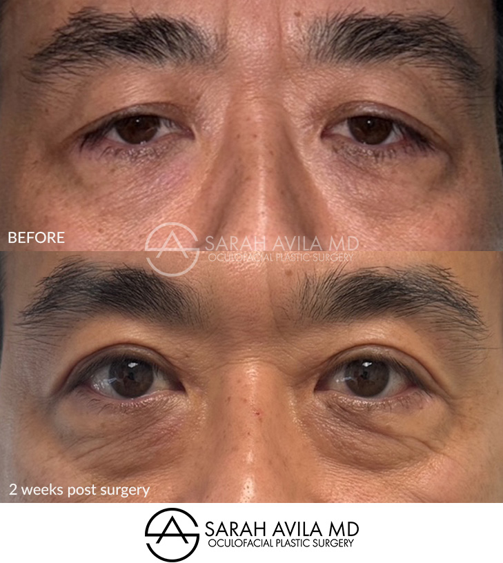 Asian Blepharoplasty Patient 5