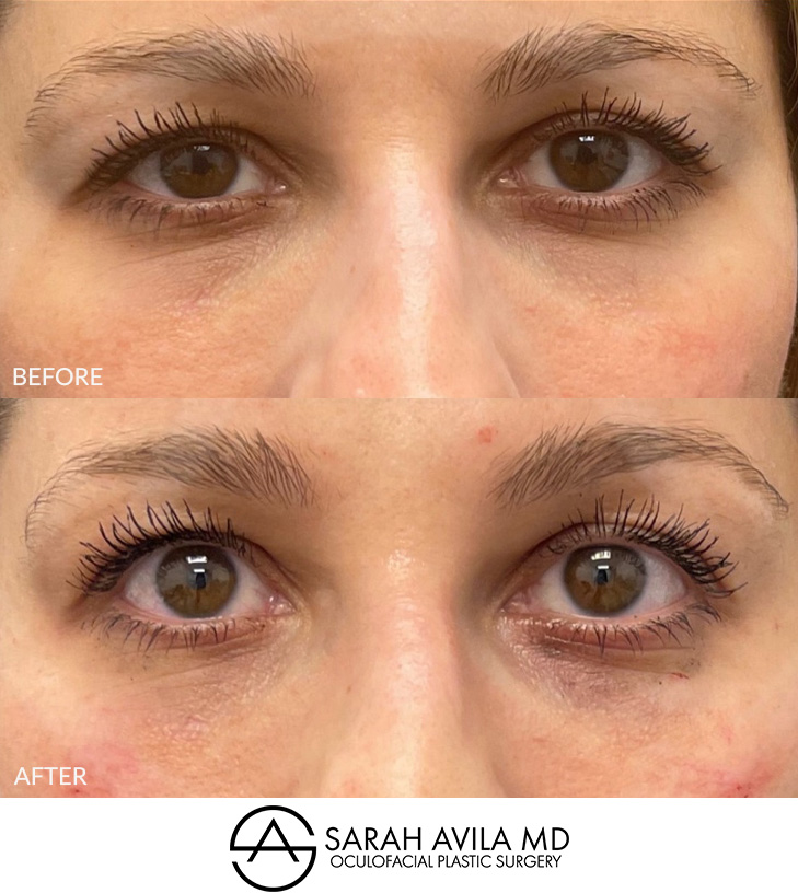 Under Eye Bags Removal Patient 2