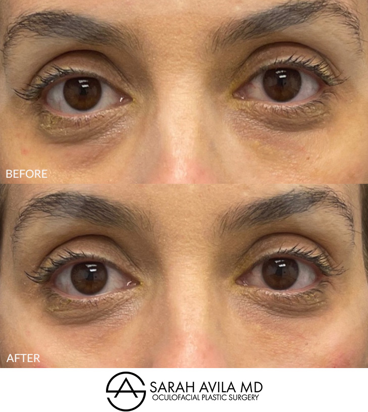 Under Eye Bags Removal Patient 3