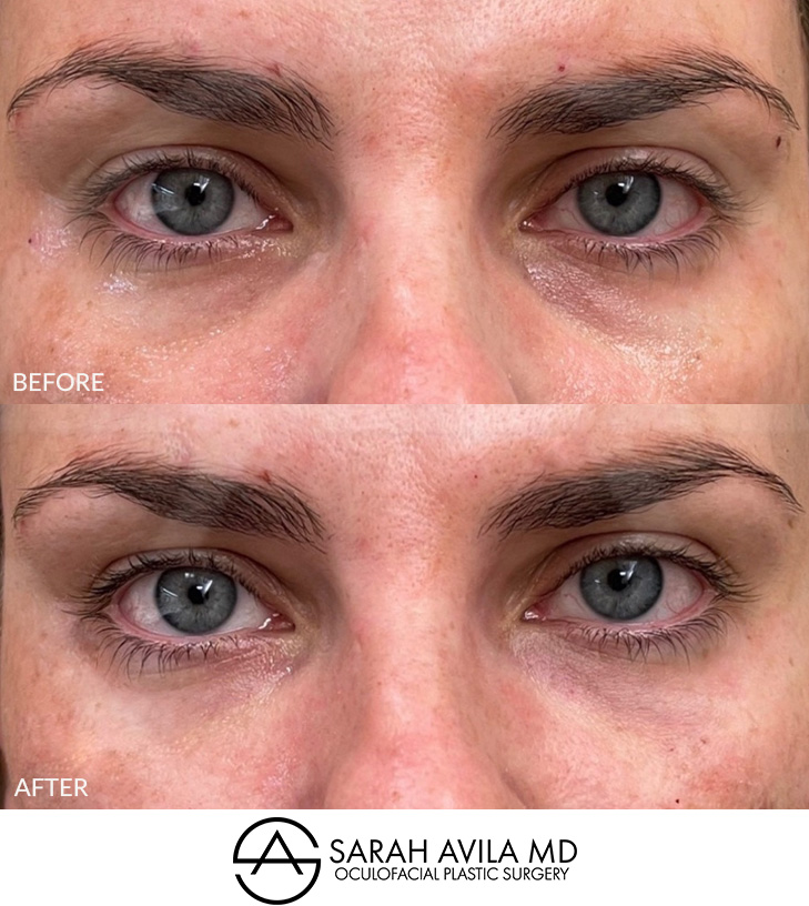Under Eye Bags Removal Patient 4