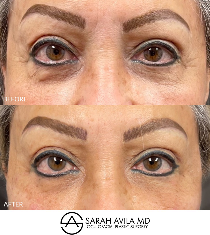Under Eye Bags Removal Patient 5