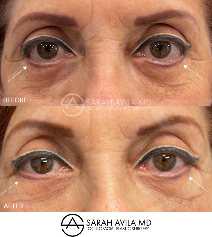 Eyelid Revision Surgery Patient 1