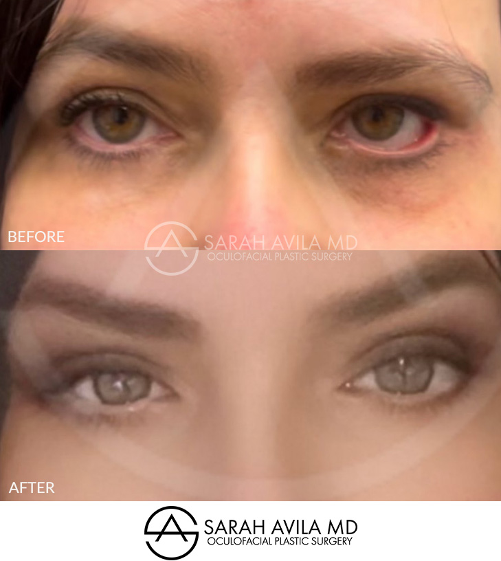 Eyelid Revision Surgery Patient 2