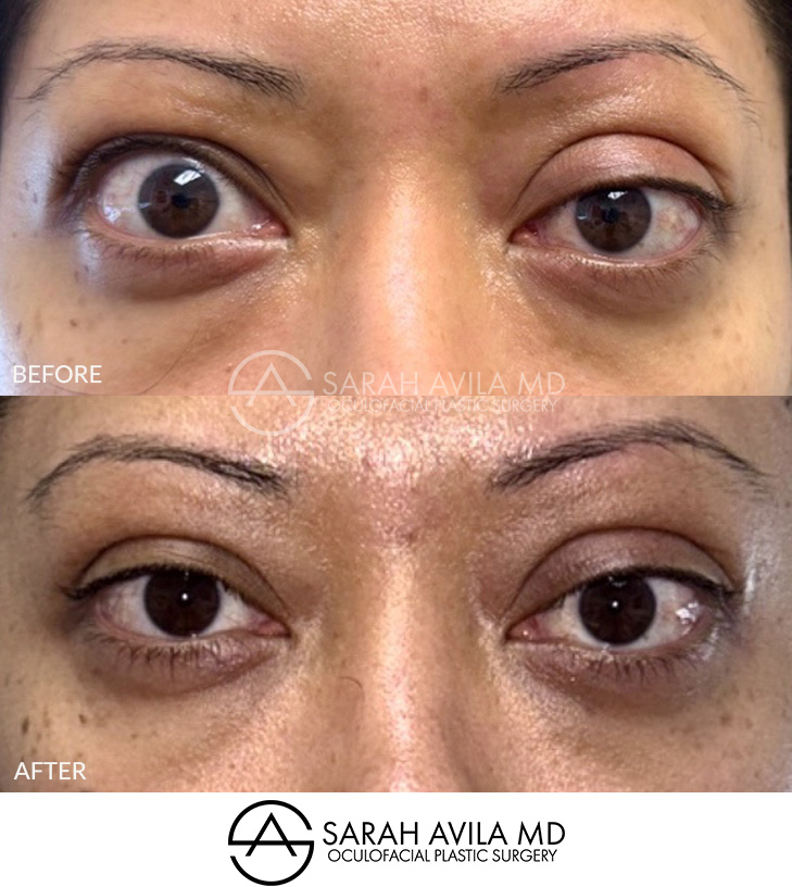 Eyelid Revision Surgery Patient 3