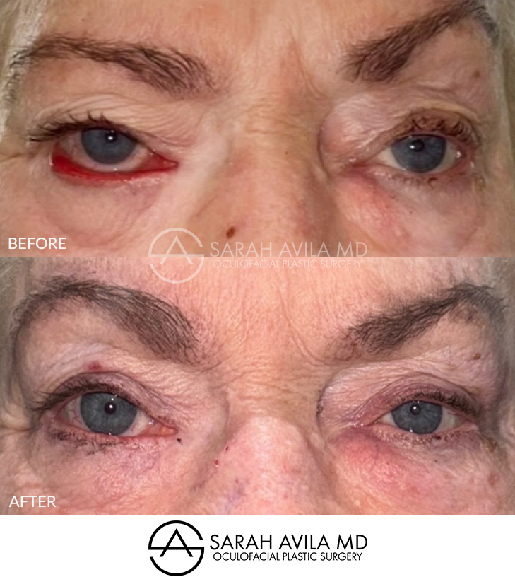 Eyelid Revision Surgery Patient 4