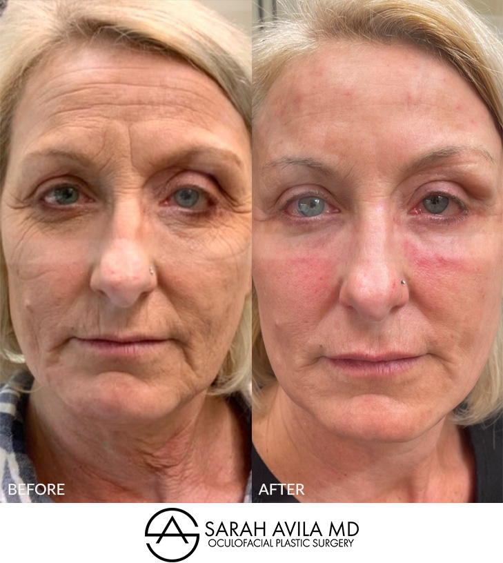 Laser Skin Resurfacing Patient 1