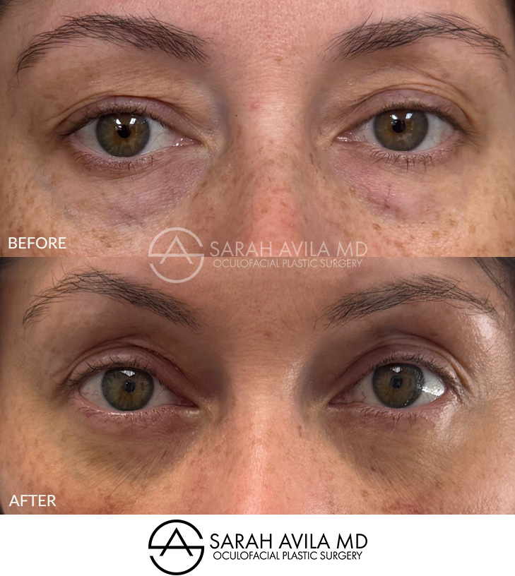 Lower Blepharoplasty Patient 1