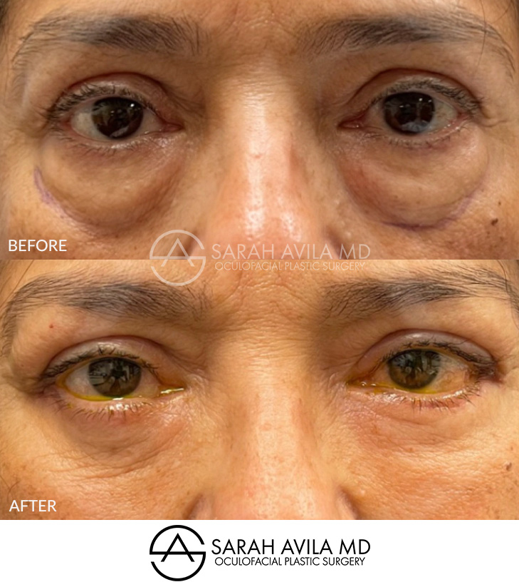 Lower Blepharoplasty Patient 10