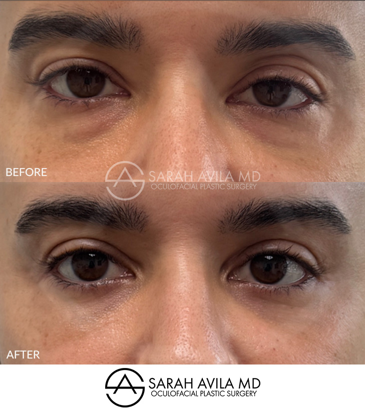 Lower Blepharoplasty Patient 11