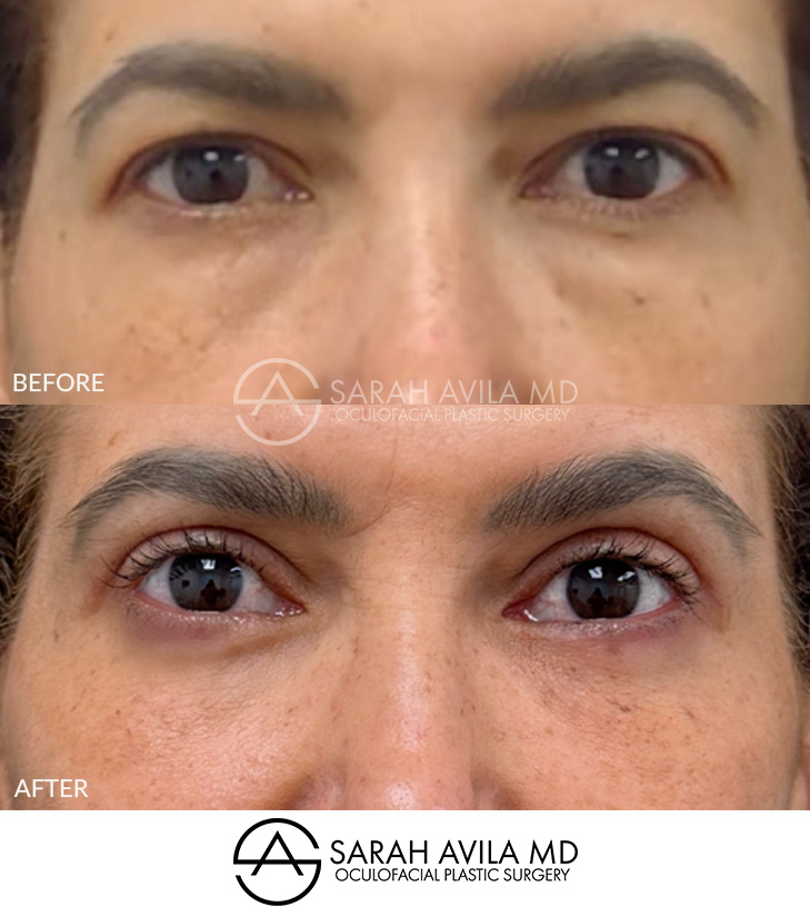 Lower Blepharoplasty Patient 12