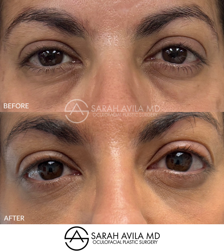 Lower Blepharoplasty Patient 13