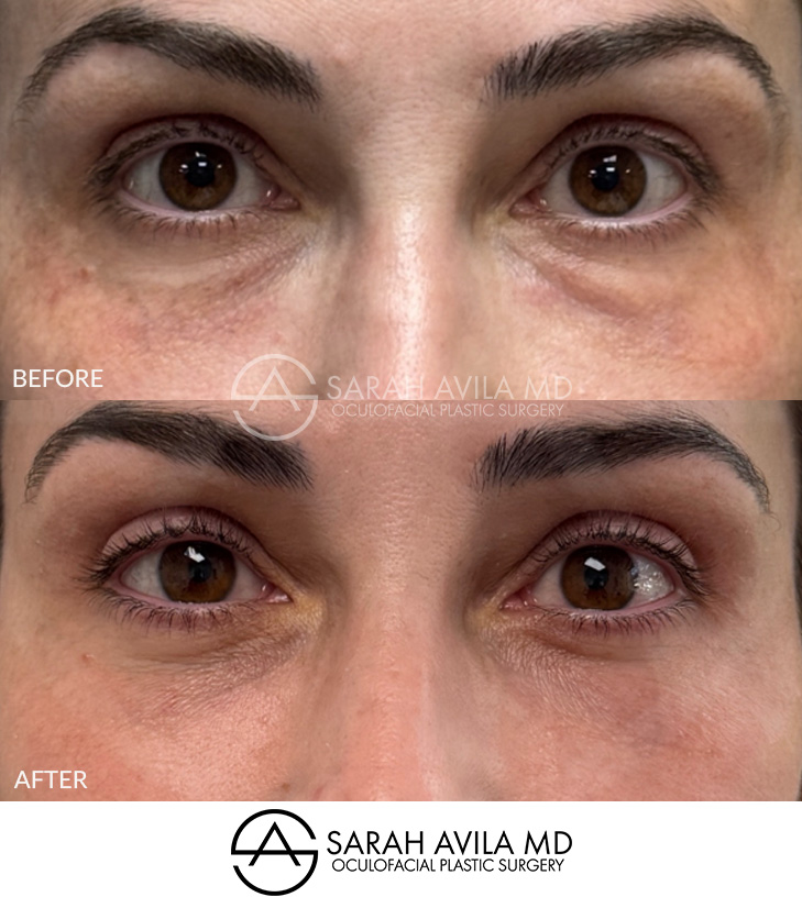 Lower Blepharoplasty Patient 14