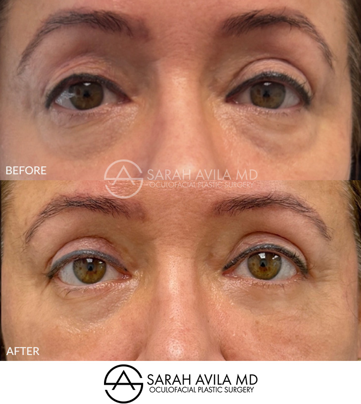 Lower Blepharoplasty Patient 2
