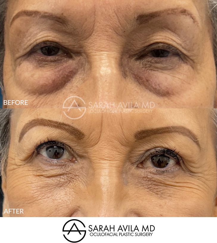 Lower Blepharoplasty Patient 3