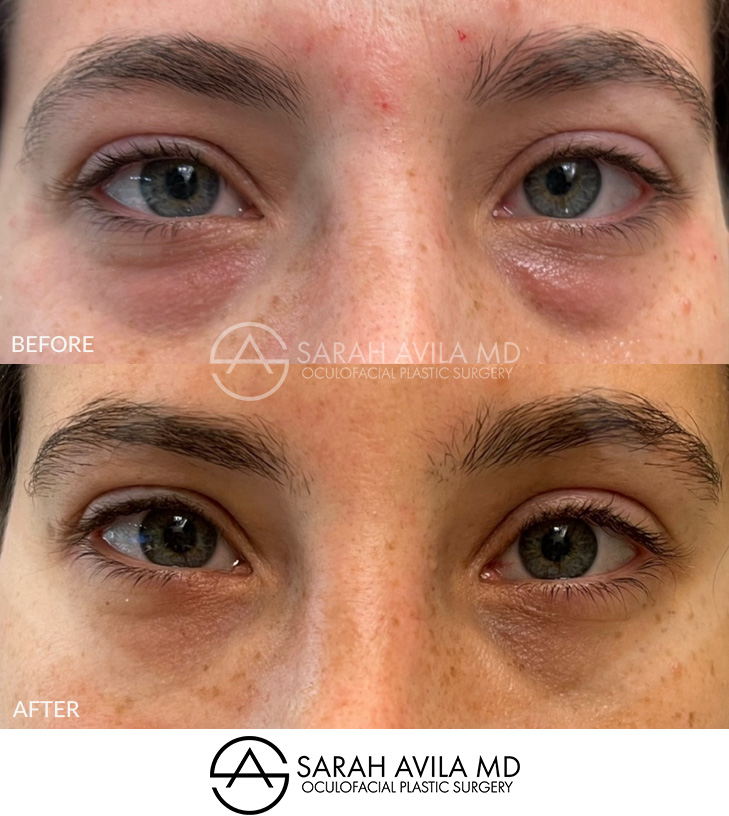 Lower Blepharoplasty Patient 4