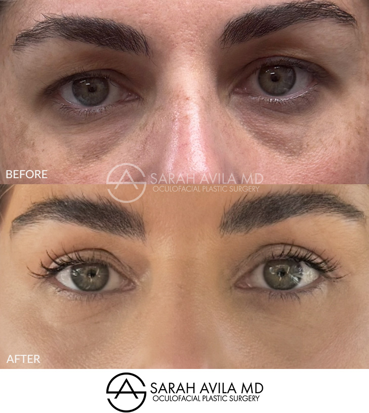 Lower Blepharoplasty Patient 5