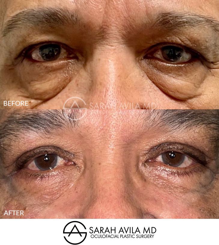 Lower Blepharoplasty Patient 6