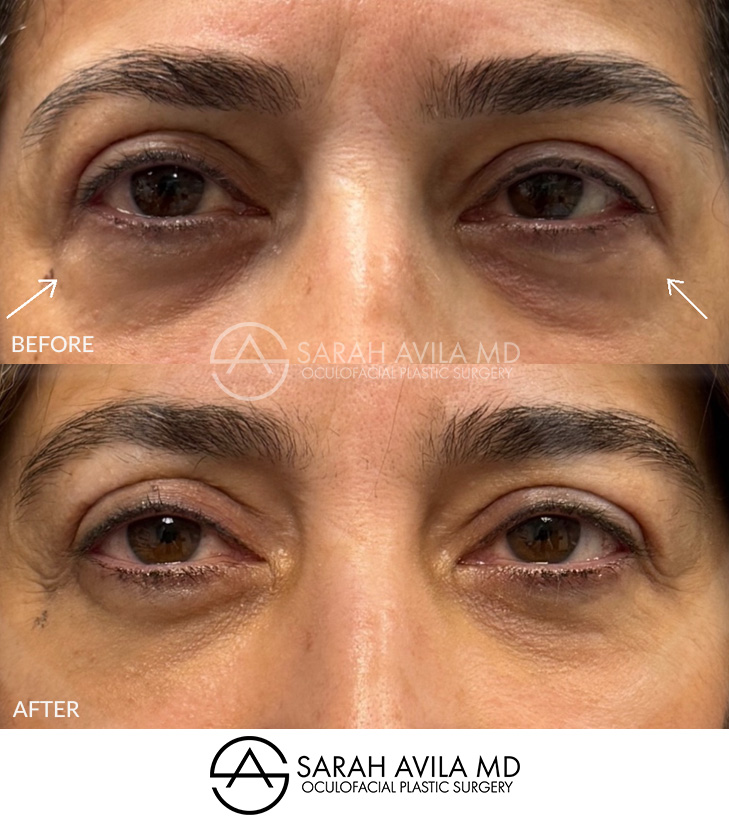 Lower Blepharoplasty Patient 8