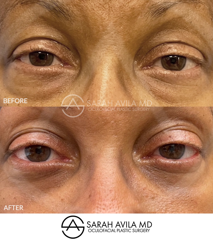 Lower Blepharoplasty Patient 9