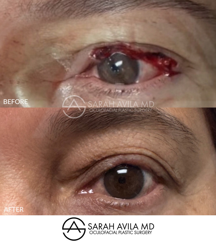 MOHS Reconstruction Patient 1