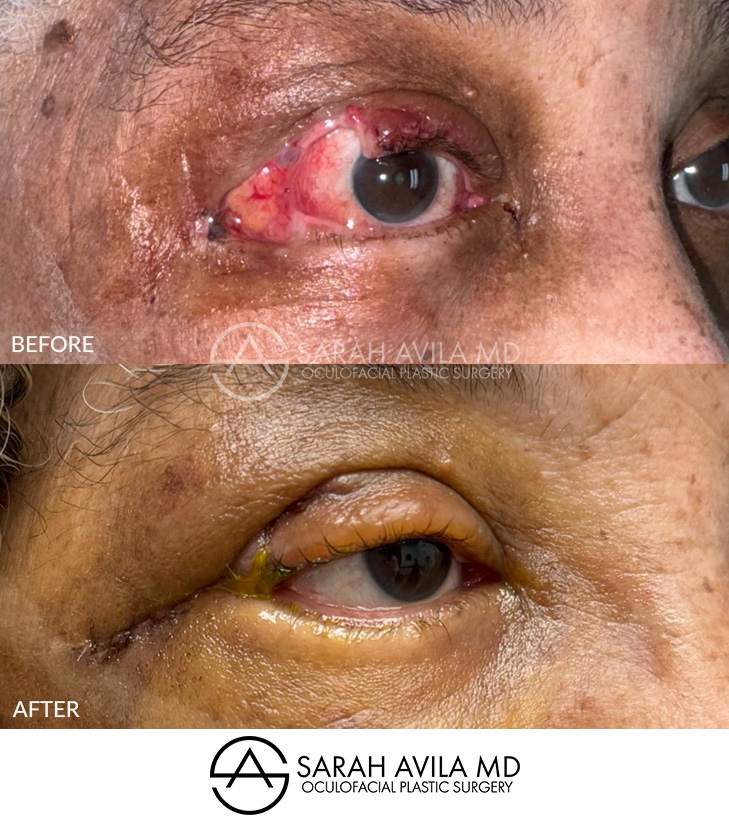 MOHS Reconstruction Patient 2
