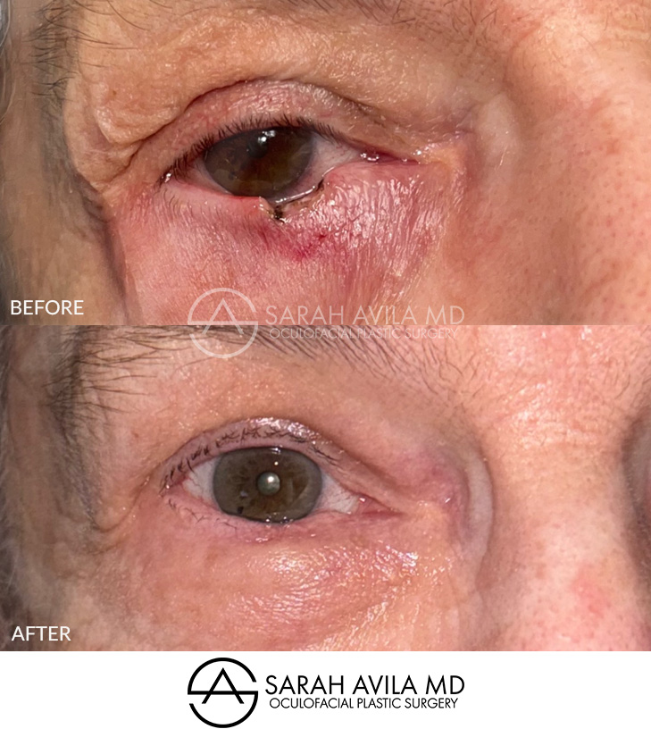 MOHS Reconstruction Patient 3