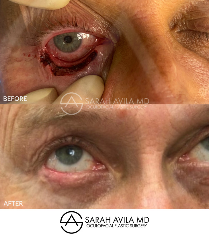 MOHS Reconstruction Patient 4
