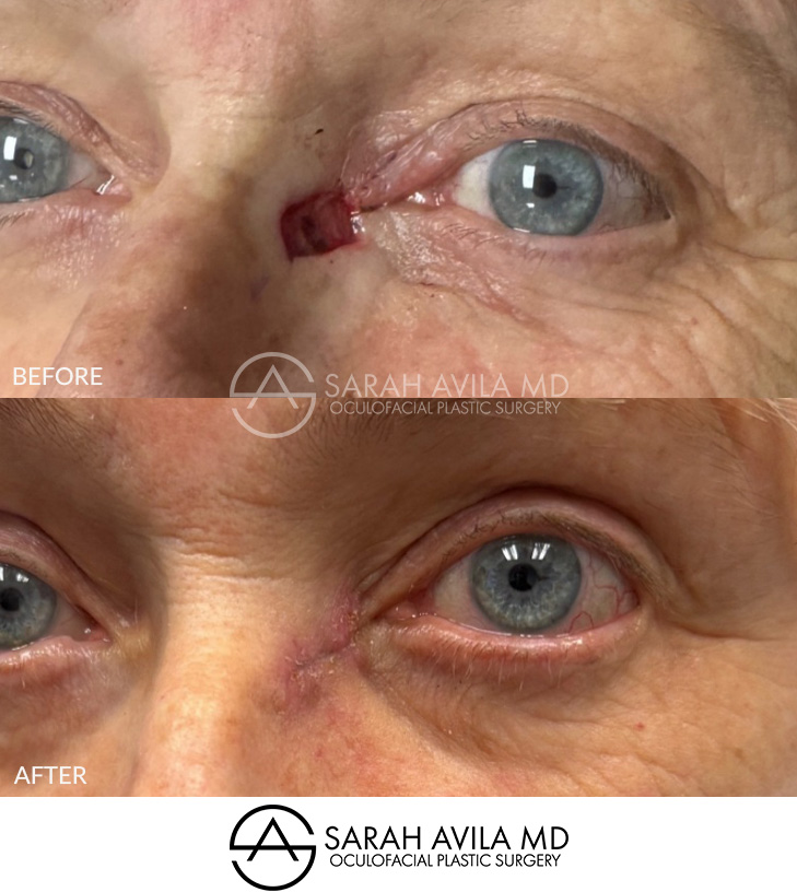 MOHS Reconstruction Patient 5