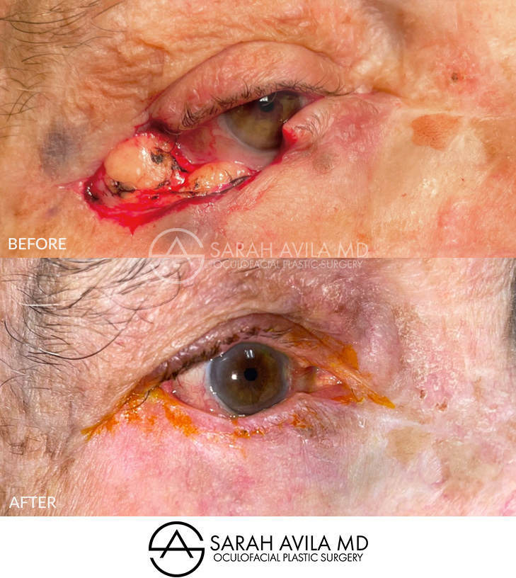 MOHS Reconstruction Patient 6