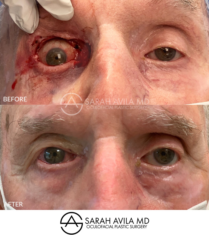 MOHS Reconstruction Patient 7