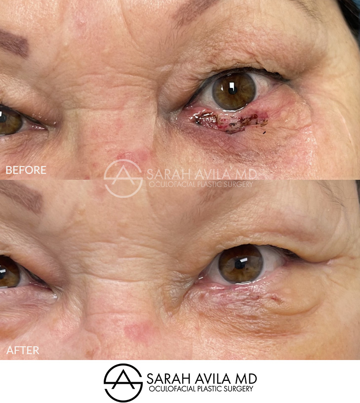 MOHS Reconstruction Patient 8
