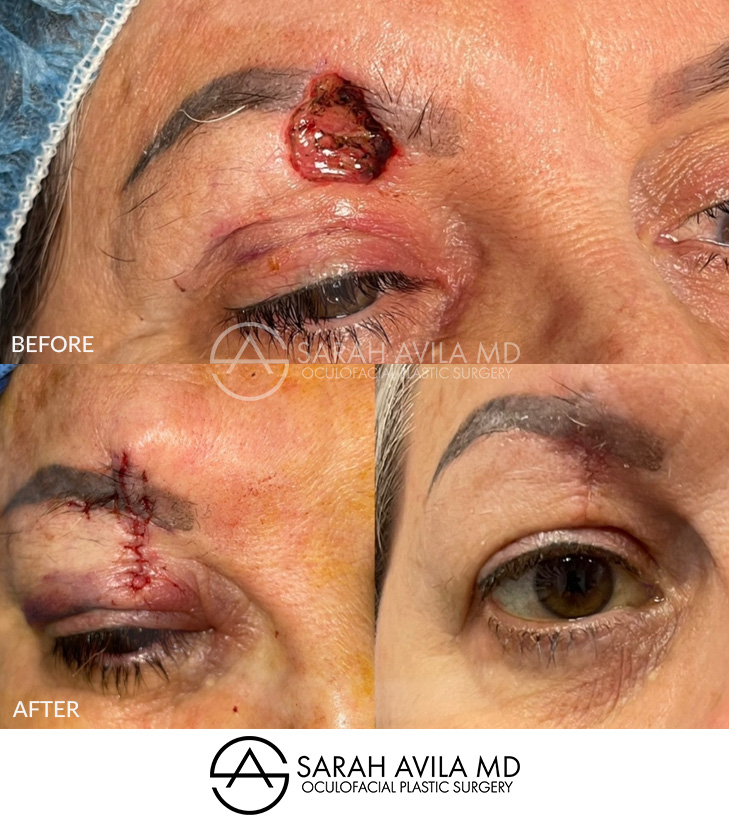 MOHS Reconstruction Patient 9