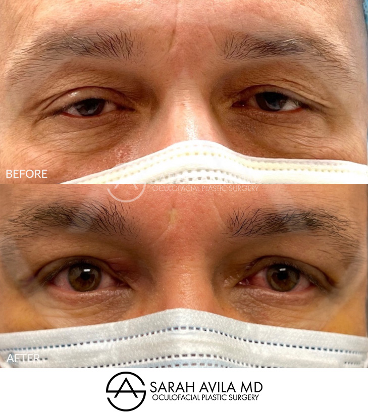 Eyelid Ptosis Patient 10
