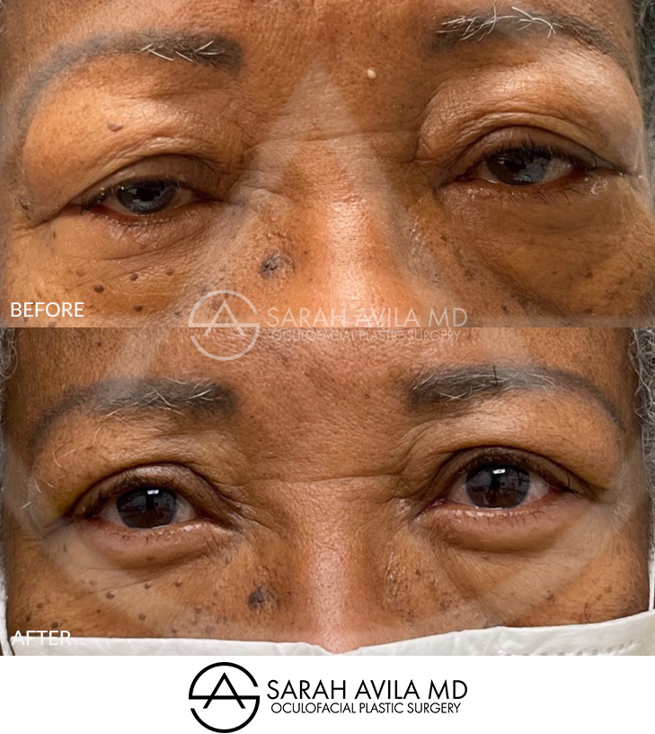 Eyelid Ptosis Patient 12